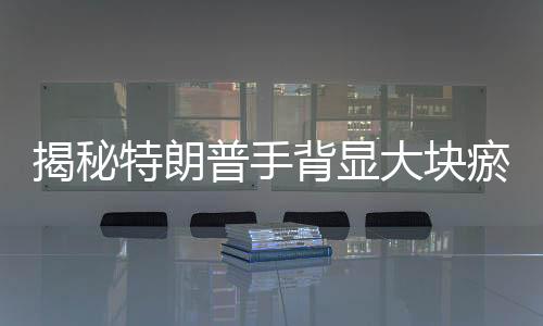 揭秘特朗普手背顯大塊瘀傷背后的故事，白宮官方解釋與爭(zhēng)議