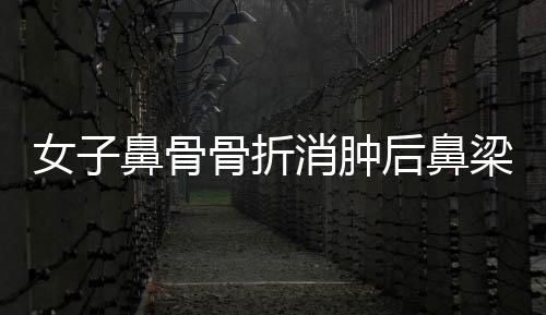 女子鼻骨骨折消腫后鼻梁高挺，重拾自信美